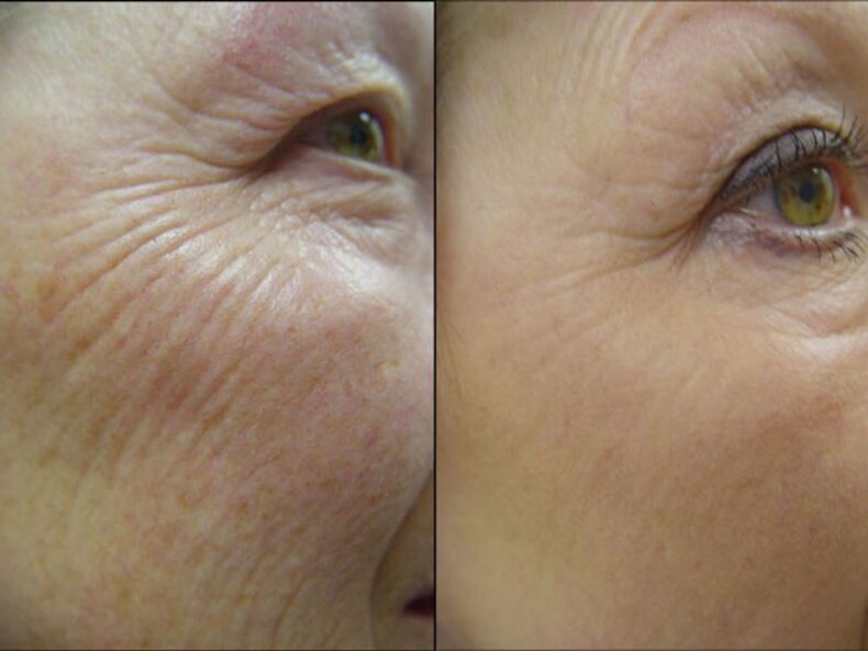 Before and after the laser rejuvenation procedure a significant reduction in wrinkles
