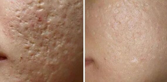 Scars laser grounding