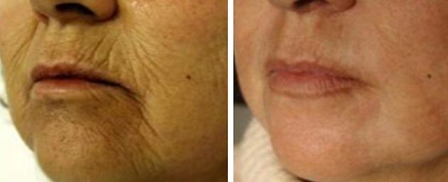 4D rejuvenation