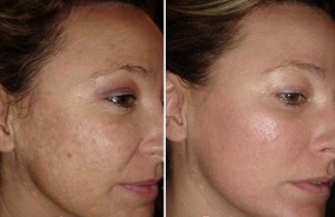 laser face skin rejuvenation before and after photos
